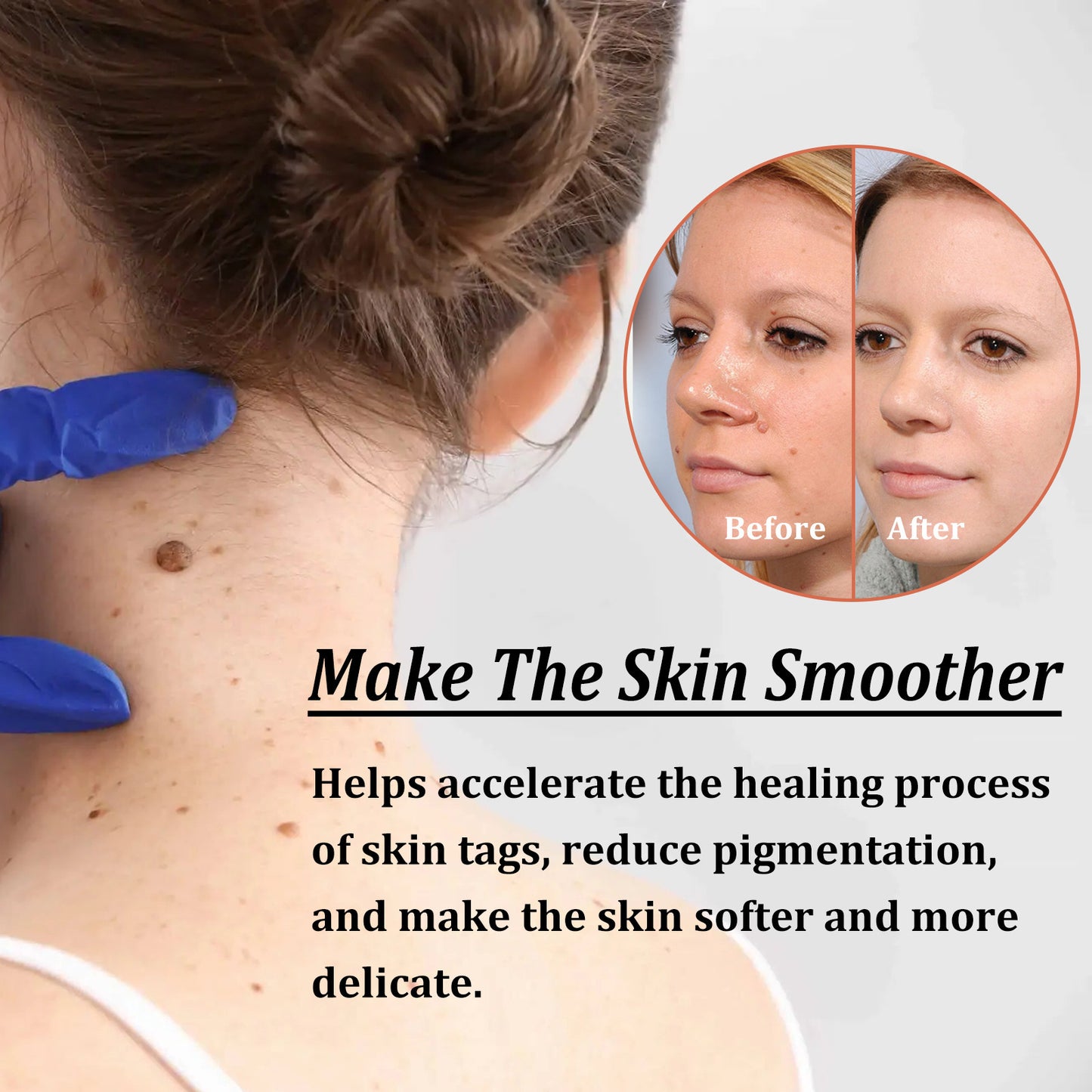OUHOE Wart Treatment Patches