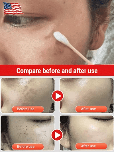 🔥Buy 1 Get 1 Free🔥7-Day Brightening and Whitening Ancient Formula Spot Removal Cream