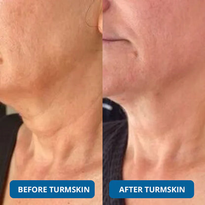 🔥3% Hyaluronic Acid Ultra Hydrating Serum by TurmSkin🔥